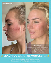 Load image into Gallery viewer, Acne Foam Cleanser
